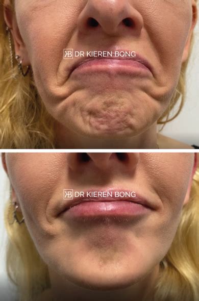 Botox In The Chin To Smooth Out Dimpled Orange Peel Appearance