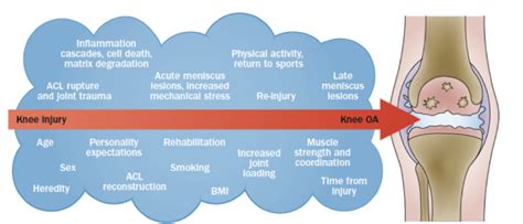 Oa After Acl Reconstruction What To Say To Patients La Trobe Sport