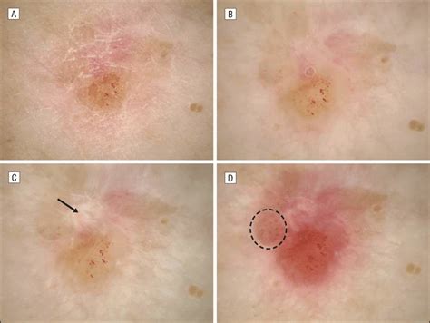 A Basal Cell Carcinoma Shown By Clinical Photography A Nonpolarized