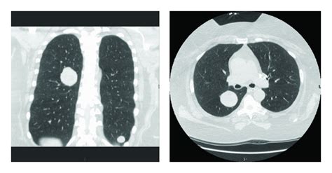 Figure 1 Benign Metastasizing Leiomyoma A Rare Type Of Lung
