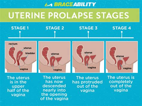 Uterine Prolapse Pregnancy