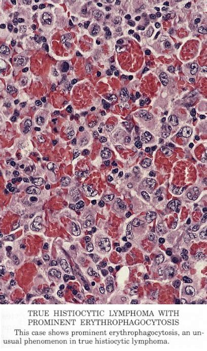 Pathology Outlines Histiocytic Sarcoma