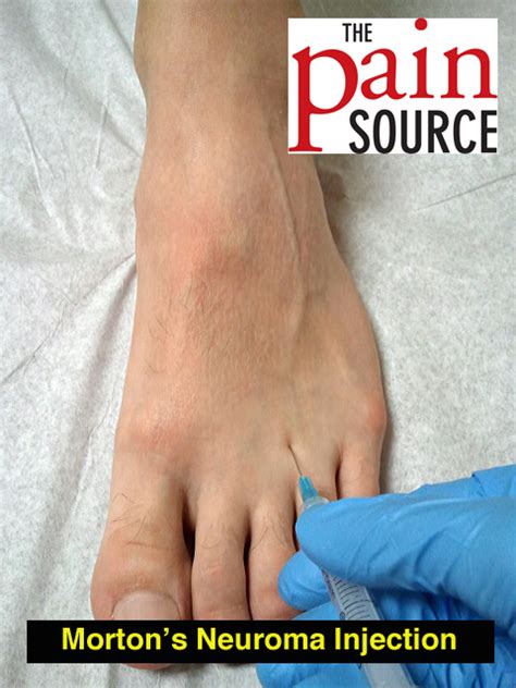 Mortons Neuroma Injection Technique And Tips The Pain Source