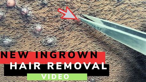 New Ingrown Hair Removals Youtube