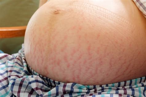 Stretch Marks With Twin Or Triplet Pregnancy Multiple Births Twinfo