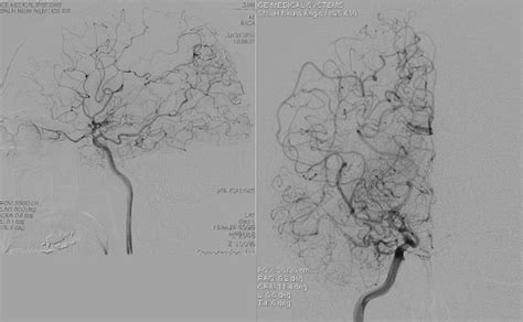 Cerebral Angiography Procedure What Does It Involve