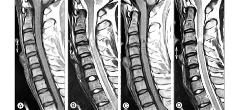 58 Year Old Man With Acute Spinal Cord Injury Mri Of The Cervical