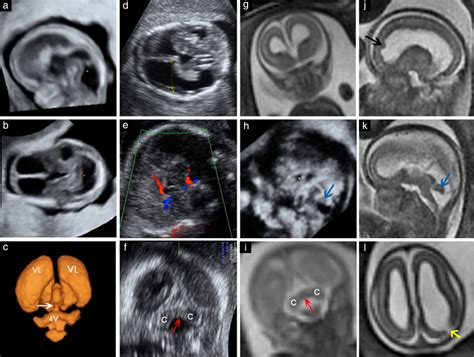 Non‐visualization Of Choroid Plexus Of Fourth Ventricle As First