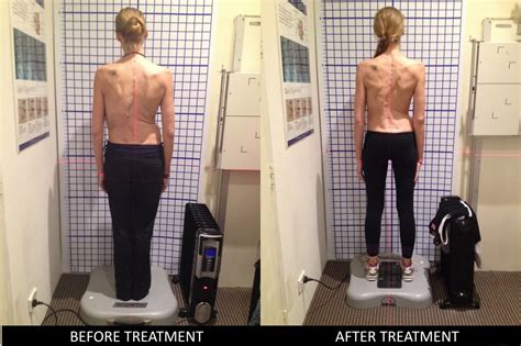 Scoliosis Case Study 5 Before And After St Judes Clinic