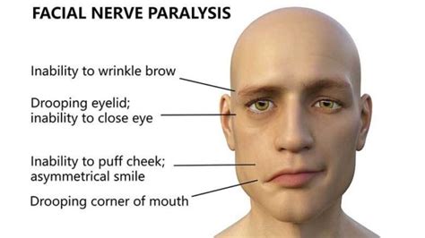 Facial Palsy Causes Symptoms Diagnosis And Treatment Public Health Notes