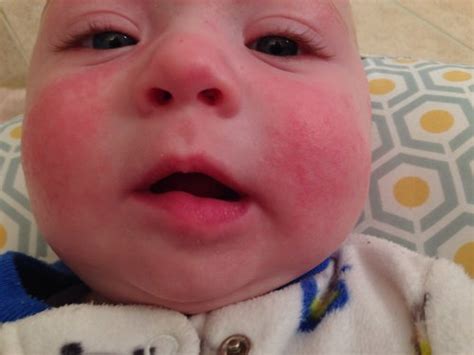 Baby Rash On Face Types Of Baby Rashes Newborn Rash Baby Rash On