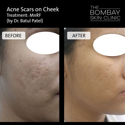 Acne Scars Treatment The Bombay Skin Clinic Acne Scar Removal Laser