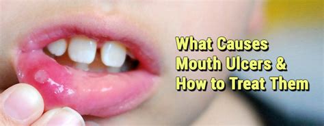 What Causes Mouth Ulcers And How To Treat Them