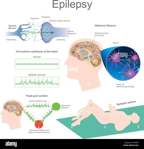 Epilepsy Is A Group Of Neurological Disorders Characterized By Epileptic Seizures Epileptic