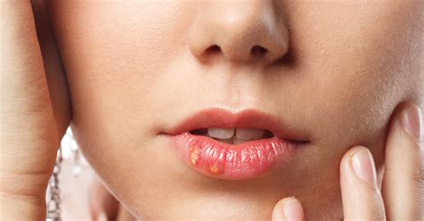 Healthool Bumps On Lips Causes Treatment Pictures 2021 Updated