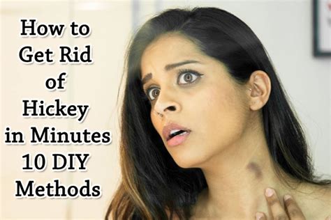 How To Get Rid Of Hickey In Minutes 10 Diy Methods