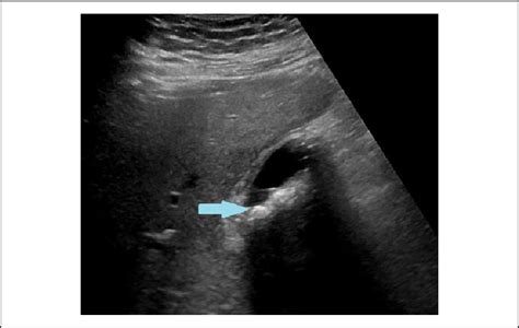 Gallbladder Ultrasound Showing Moderate Thickening Of The Gallbladder