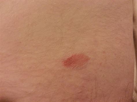 About A Month Ago I Noticed A Blood Blister On The Side Of