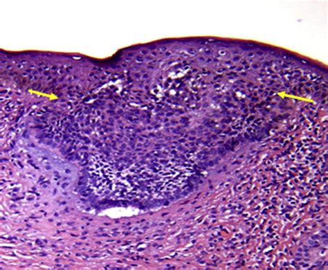 Spoke Wheellike Structures In Superficial Basal Cell Carcinoma A Correlation Between