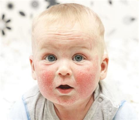 5 امراض جلدية تصيب الاطفال الرضع مجلة هي