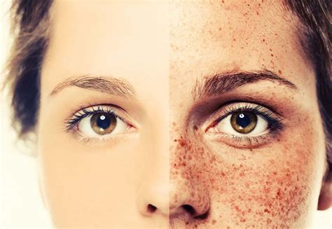 How To Remove Freckles Skin Care Top News