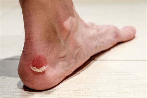 Should You Pop A Blister And Other Tips To Prevent And Heal Blisters