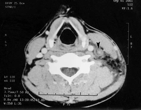 Ct Scan Of The Neck Revealing Thrombosis Of The Left Internal Jugular