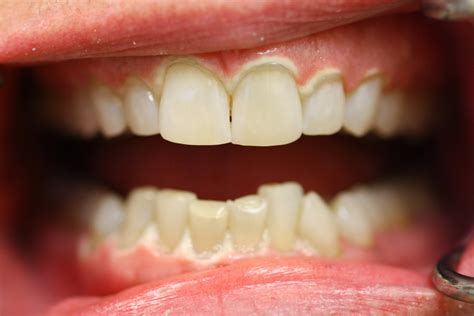 Crescent Dental On Blogspot Kor 1 Hour In Office Deep Bleaching