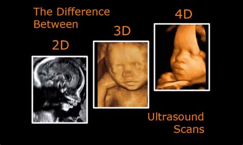 What Is The Difference In 2d3d And 4d Fetal Flix Fetal Flix