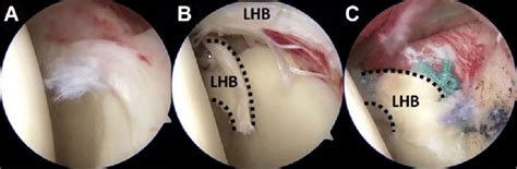 Repair Of Type Iv Superior Labral Anterior Posterior Slap Lesion A
