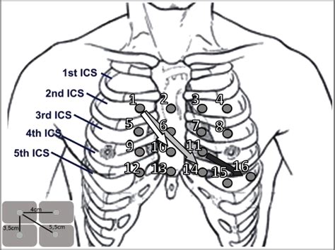 Figure 1 From Precordial Electrode Placement For Optimal Ecg Monitoring