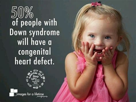 Heart Problems In Down Syndrome