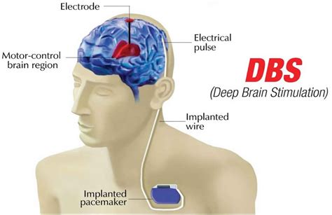 Deep Brain Stimulation Pictures