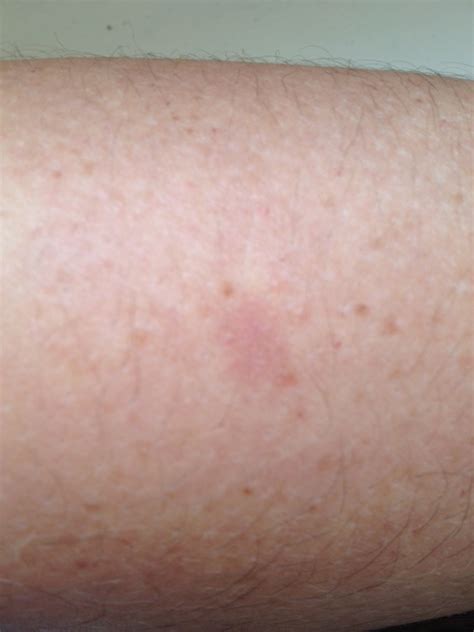 I Have A Rash On My Lower Arm In The Area That Is Usually