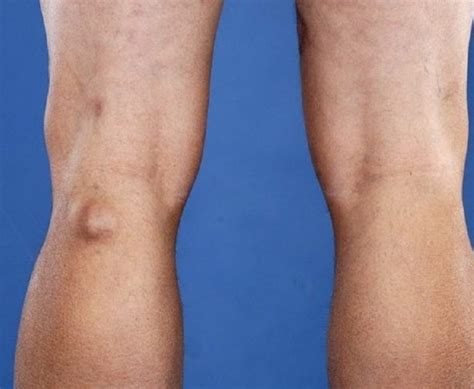 Bakers Cyst Popliteal Cyst The Foot And Ankle Clinic