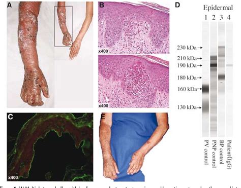 Figure 1 From Bullous Pemphigoid Associated With Ischemic
