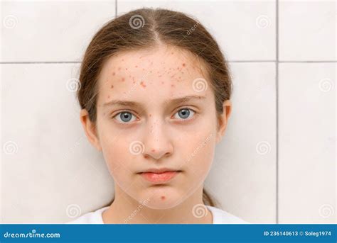 Cara De Una Adolescente Con Acné De Granos En El Retrato De La Piel De Una Muchacha De Pubertad