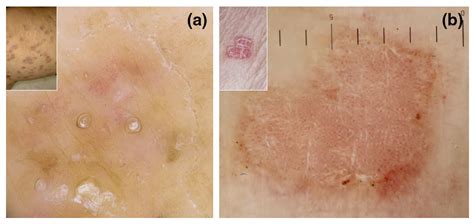 Dermoscopy Of Porokeratosis Results From A Multicentre Study Of The