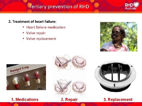 Diagnosis And Management Of Rheumatic Heart Disease Dr