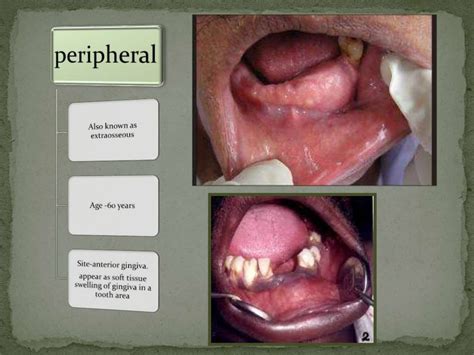 Pindborg Tumor By Anchal Mehra