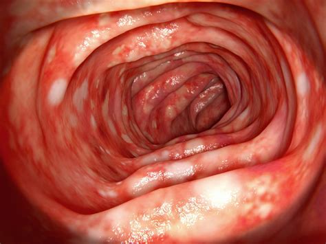 Lipitor May Be Effective Treatment For Ulcerative Colitis