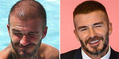 David Beckham Before After Hair Transplant Asli Tarcan Clinic