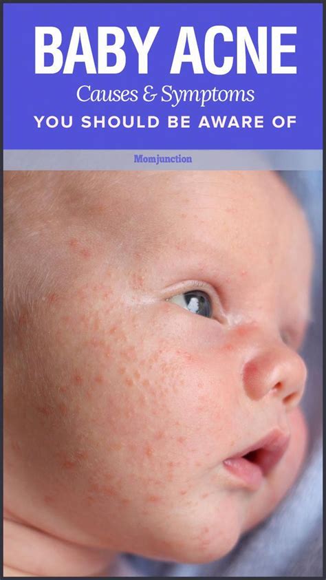 Clarifywebdesign Newborn Baby Acne Treatment