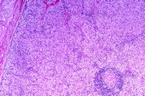 Lymph Node Atypical Mycobacterial Infection Mai Flickr