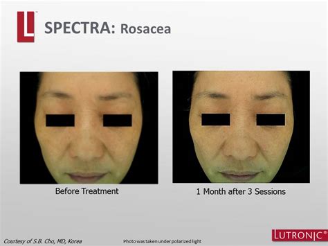 Hollywood Spectra Carbon Peel Surface Clinic