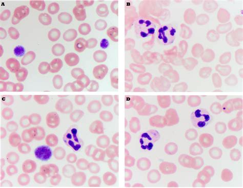 Peripheral Blood Smear Revealing Giant Platelets And Neutrophils