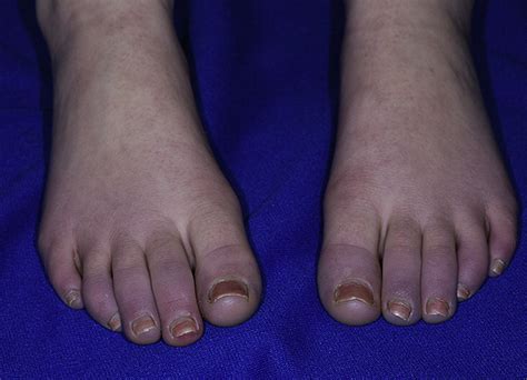 Blue Toes After Stimulant Therapy For Pediatric Attention Deficit