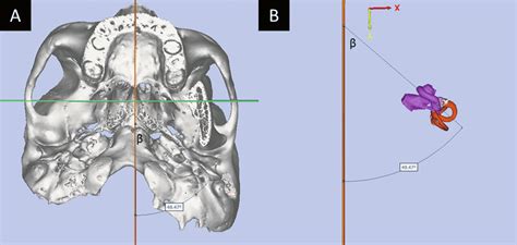 Anatomical Variations Of The Human Cochlea Determined From Micro‐ct And