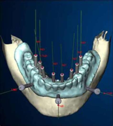 In simple terms, computer guided surgery is similar to that of satellite navigation (gps) used in cars. Dental Technology - 3D CT Scanning - Digital X-Rays