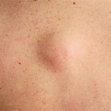 The accumulation of white blood cells to the infected area causes pus to develop. A Guide To Raised Bumps On Your Skin - Red Moles, Brown ...